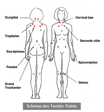 Fibromyalgie